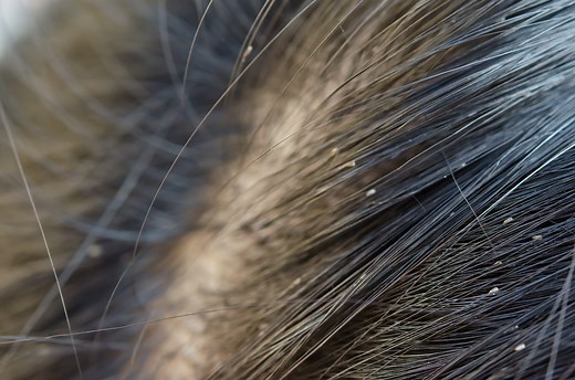 Poux (corps, cheveux) : photos, types, piqûres, taille