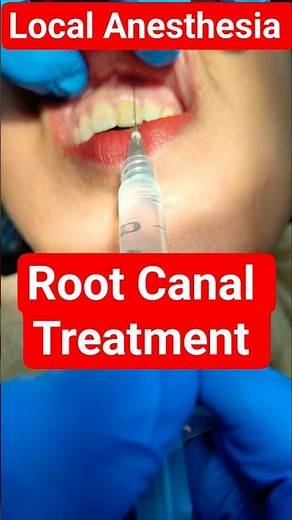 Local Anesthesia #RCT #Root Canal Treatment #Dentist #endodontist #root canal specialist # dental