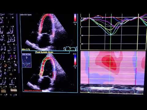 Global Longitudinal Strain (GLS)🫀