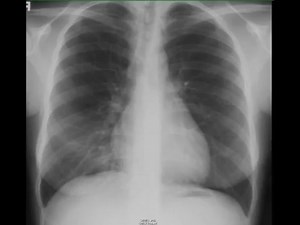 1.1K views · 19 reactions | X-ray Sunday Right Middle Lobe Atelectasis | CTisus: Cutting edge information on body CT (Computed tomography). | Facebook