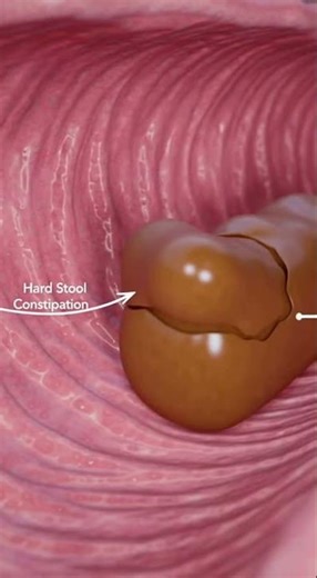 How Constipation Blocks Your Colon | 3D Digestive System Animation