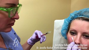 See the Procedure: Volbella Demonstration for Under the Eyes