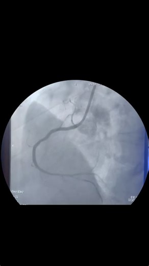 Başarılı RCA CTO Olgusu – (Başka merkezde başarısız önceki girişim sonrası)