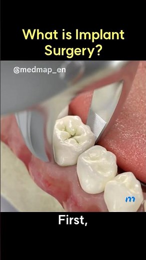 What is Implant Surgery?