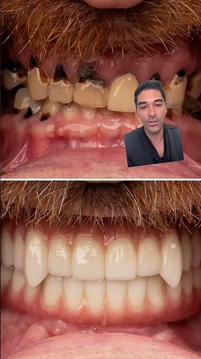 Dental Implant Vampire Fangs Transformation