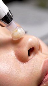 Welcome to a deeply relaxing ASMR blackhead removal experience. In this whisper-soft skincare session, enjoy ultra-realistic 4K close-up shots as blackheads gently lift out using a professional pore vacuum. Every sound is captured intentionally—soft suction, gentle tool movements, calming breathing—designed to give you tingles, relaxation, and pure satisfaction. This ASMR facial cleaning video is completely clean, safe, non-graphic, and fully monetizable. No popping, no harsh pressure, no blood—