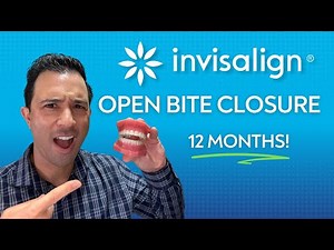 Closing A COMPLETE Open Bite with Invisalign ONLY in 12 MONTHS!