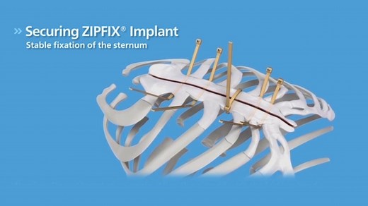 Sternal ZIPFIX™ System | DePuy Synthes