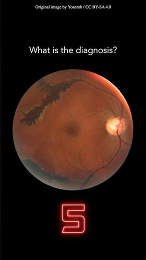 Fundoscopy Question 21