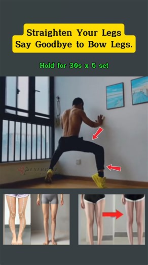 Straighten Your Legs—Say Goodbye to Bow Legs #fblifestyle | Exercise Guide
