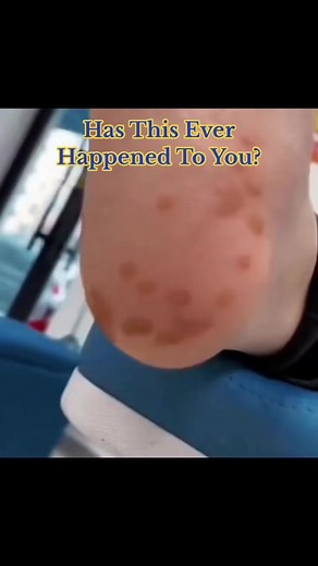 Plantar Warts Removal Procedure Explained