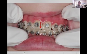 Best Case Finishing Tips