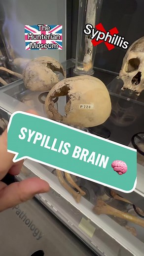Syphillis Brain 🧠 - Al Capone's Medical Mystery Unveiled