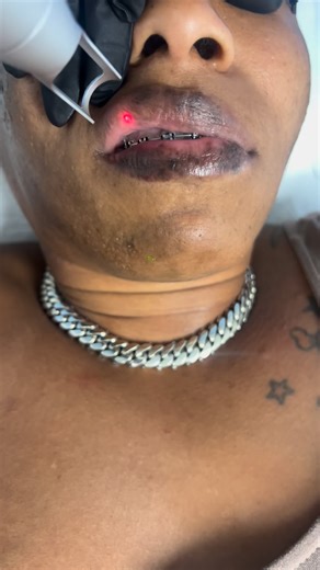Nurse Roni B. Laser Dermatology Expert on Instagram: "PICO LASER FOR DARKENED LIPS Lip hyperpigmentation (smokers lips) is multifactorial—commonly driven by melanin overactivity, chronic inflammation, hormonal influences, trauma, and smoking. 💙 Smoking reduces oxygenation, increases vascular constriction, and triggers inflammatory pathways that stimulate excess melanin, especially in delicate lip tissue. This makes lip pigmentation uniquely sensitive and unsuitable for aggressive or generic tre