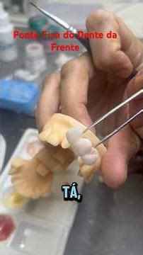 Fixed bridge for the incisor tooth. #dentist