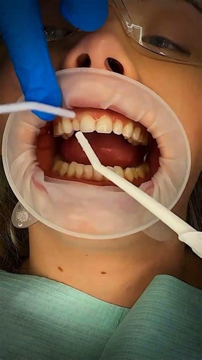Gum Lift and Composite Veneer Transformation | Fixing a Gummy Smile