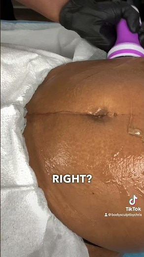 Body Sculpting Tip: Lipo Cavitation Technique