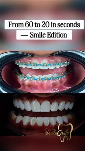✨ Witness the magic of your first smile moment! At Dental Design Smile, every transformation is crafted with precision, harmony, and artistry — because your smile deserves nothing less. 💎 From your first consultation to your final reveal, our team ensures a luxury experience with free VIP transportation and hotel stay in Miami. 🌴 📩 DM us “MIAMI” to begin your smile transformation today. #DentalDesignSmile #MiamiSmile #SmileTransformation #PorcelainVeneers #SmileDesign #CosmeticDentistry #Smil