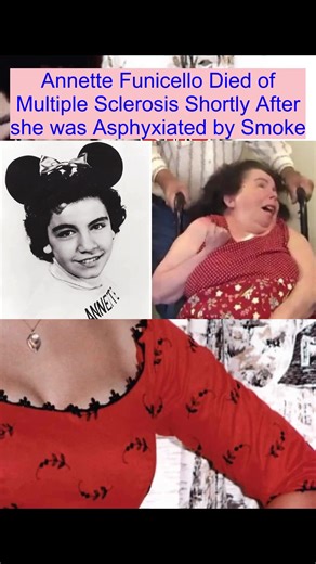 Annette Funicello Died of Multiple Sclerosis Shortly After she was Asphyxiated by Smoke