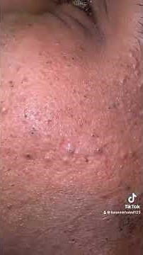 From Blackheads to Clean Skin #skincare #skincareroutine