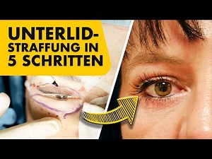 Meine Unterlidstraffung live im OP erklärt! (ohne Blut)