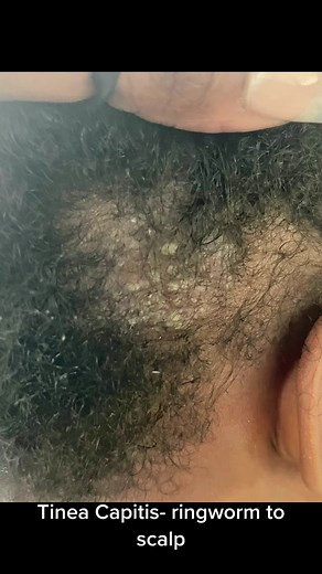 Effective Tinea Capitis and Scalp Ringworm Treatment for Kids