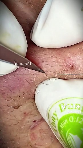 pimples on faces #brufoli #cravos #blackhead #zit #popper #acne #zits #pimplepop #pimple #fyp #fypシ #popping #asmr #pimples #abscess #usa #Satisfying #skin #cleansing