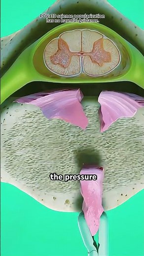Cervical Discectomy Procedure (3D Animation)