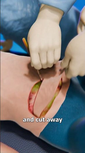 How Excess Skin Removal Surgery Works 🤔