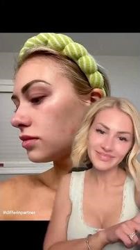 Differin Gel is Your Ride or Die for Acne