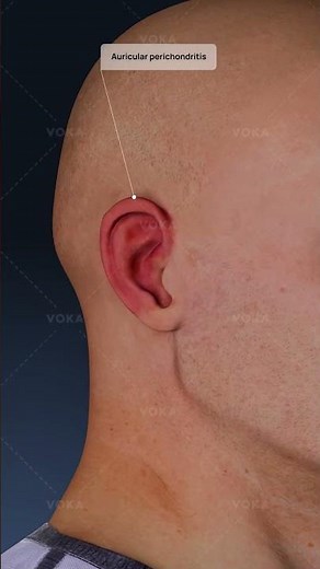What is Auricular Perichondritis and why should you be concerned? Explained in 3D