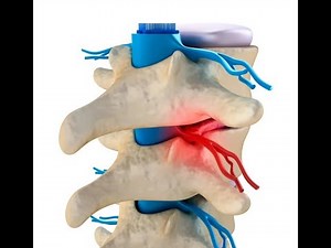 Laminotomy | Laminectomy | Hemilaminectomy | Foraminotomy | Facetectomy | Laminoplasty | Discectomy