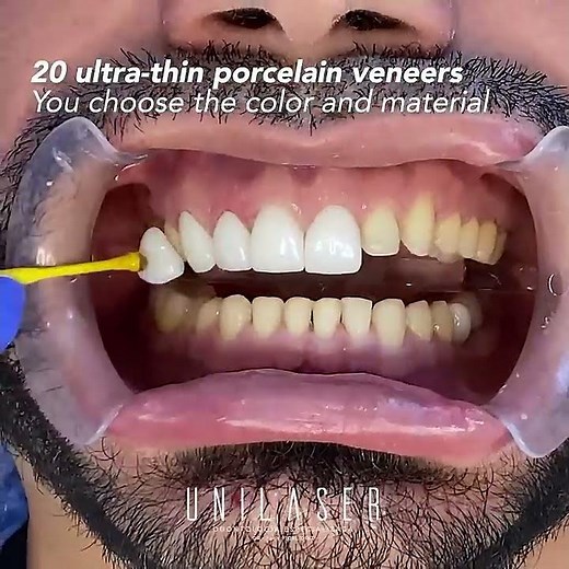 Porcelain veneers. This is how we do it