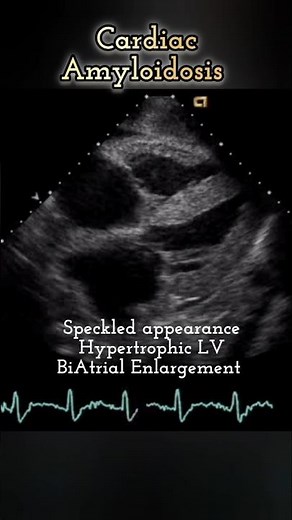 Speckled appearing Hypertrophic LV and BiAtrial Enlargement suggests Amyloidosis #heart