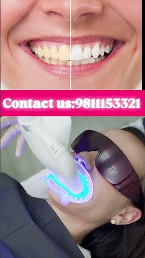 Teeth whitening (Bleaching)procedure #zoom