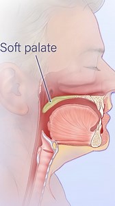 Penn Otorhinolaryngology | The soft palate is an area of muscle that separates the nasal cavity from the oral cavity. A collapse of the soft palate can block the flow... | Instagram