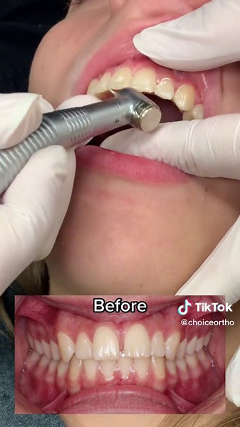 🦷 Tooth Shaving 🪒 Check out what a difference reshaping the edges of your 🦷 can make when your #braces come off. #drwindhorst #choiceorthodontics #bracesoff #toothshaving #enameloplasty #transformation #transformationtuesday #orthodontist #orthodontics #orthodontistsoftiktok