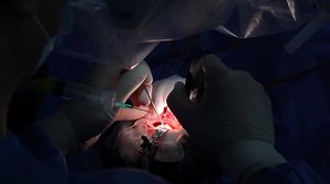 clip-1090889301-treatment-brain-aneurysm-surgical-operation-on-team