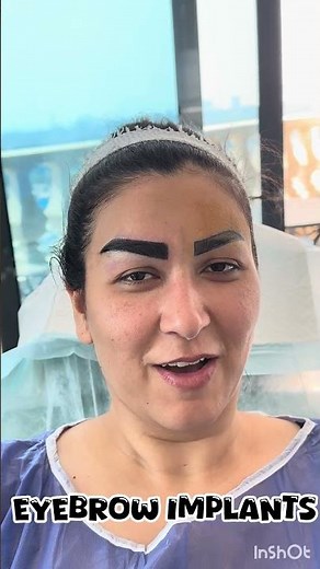 Natural Eyebrow Transplant | Before & After Amazing Results