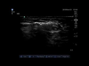 Ultrasound guided sural nerve block.