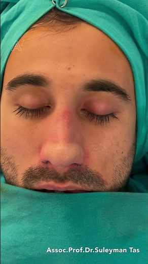 Thick Skinned Male Rhinoplasty | Before and After