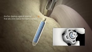 Q-FIX MINI All-Suture Anchor Technique Animation