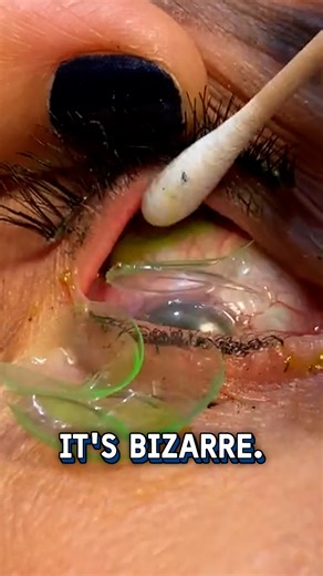 She had 23 contact lenses stuck in her eye 👁️😱 #eyes #contactlenses #fail | UNILAD Tech