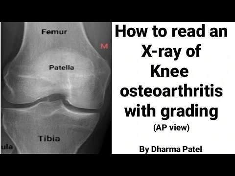 How to read knee joint X-ray in knee osteoarthritis | Normal Knee X ray | Ortho X ray interpretation