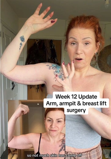 12-Week Arm Lift Surgery Recovery Update