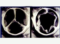 TAVI - Implante Percutâneo de Válvula Aórtica - Clínica Saadi