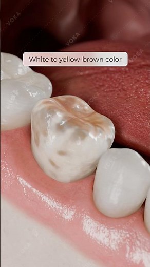 Molar Incisor Hypomineralization (MIH): Developmental Enamel Defects in 3D