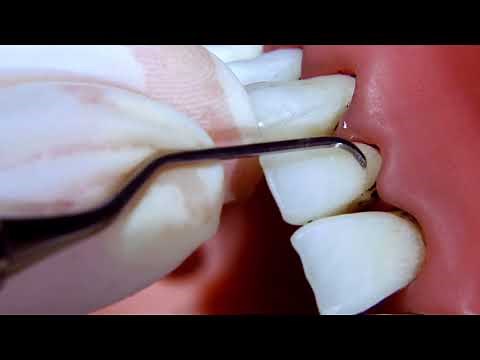 Instrumentierung Gracey-Kürette: 5/6 Mini