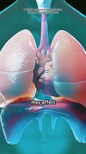 Pectus Excavatum And Nuss Procedure (3D Animation)