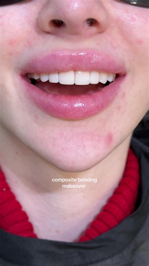 8 teeth composite bonding (a mix of composite veneers and edge bonding) to replace an old composite and create more even lengths of the teeth 🤍